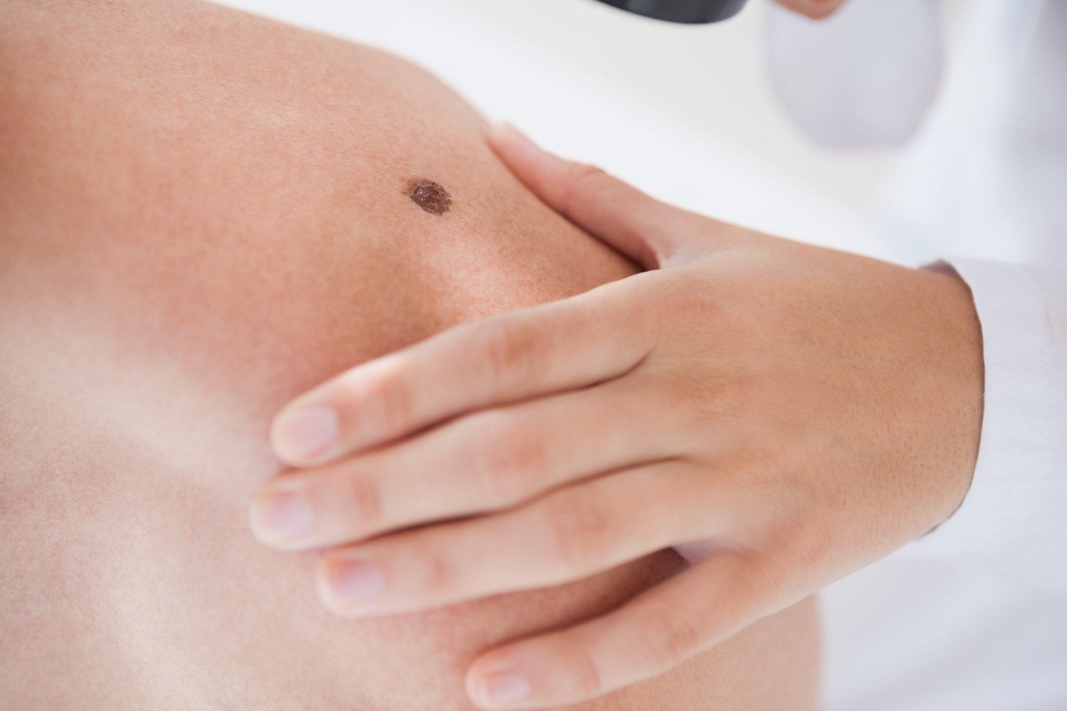 Mão tocando uma pinta na pele do corpo humano.