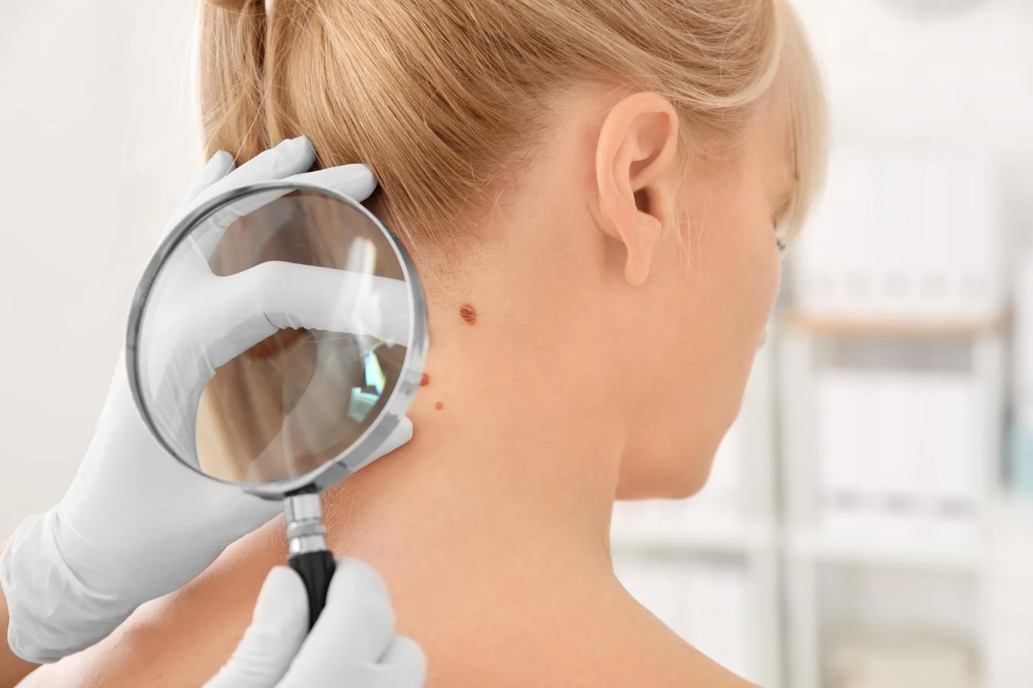Médico segurando uma lupa enquanto examina uma pinta na nuca de uma paciente, em um consultório médico.
