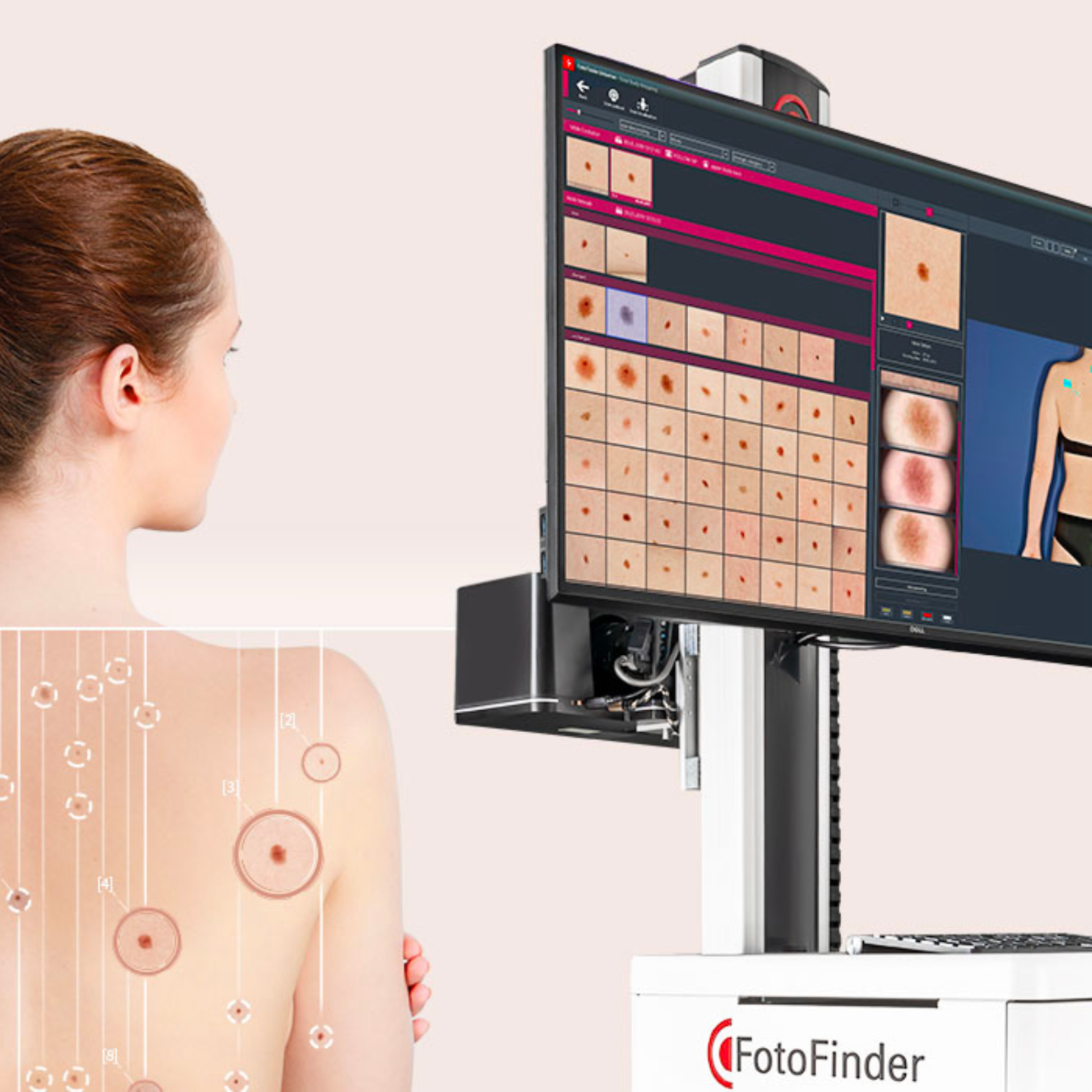 Mulher em consulta de pele com tela de computador exibindo várias imagens de marcas de nascença ou manchas pigmentares na pele.