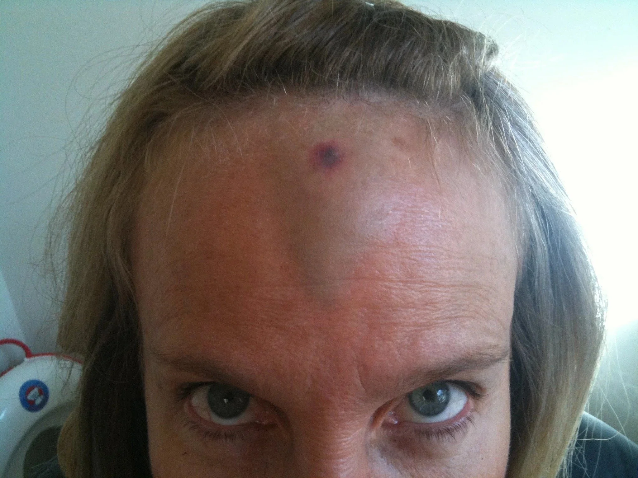 Close-up of a person's forehead with a dark pimple or blemish on the skin.