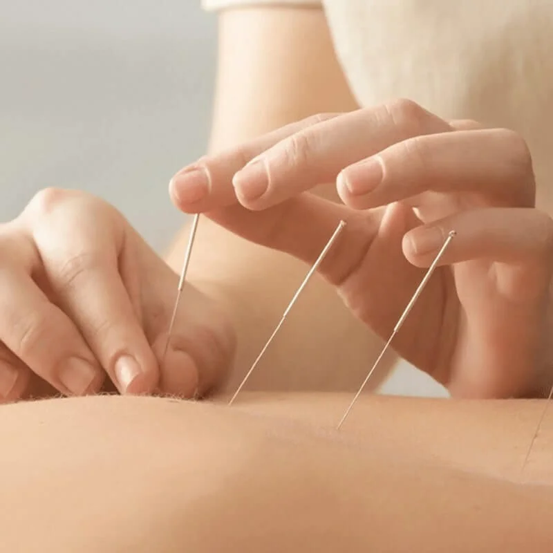 Top 10 Reasons Why You Should Try Acupuncture