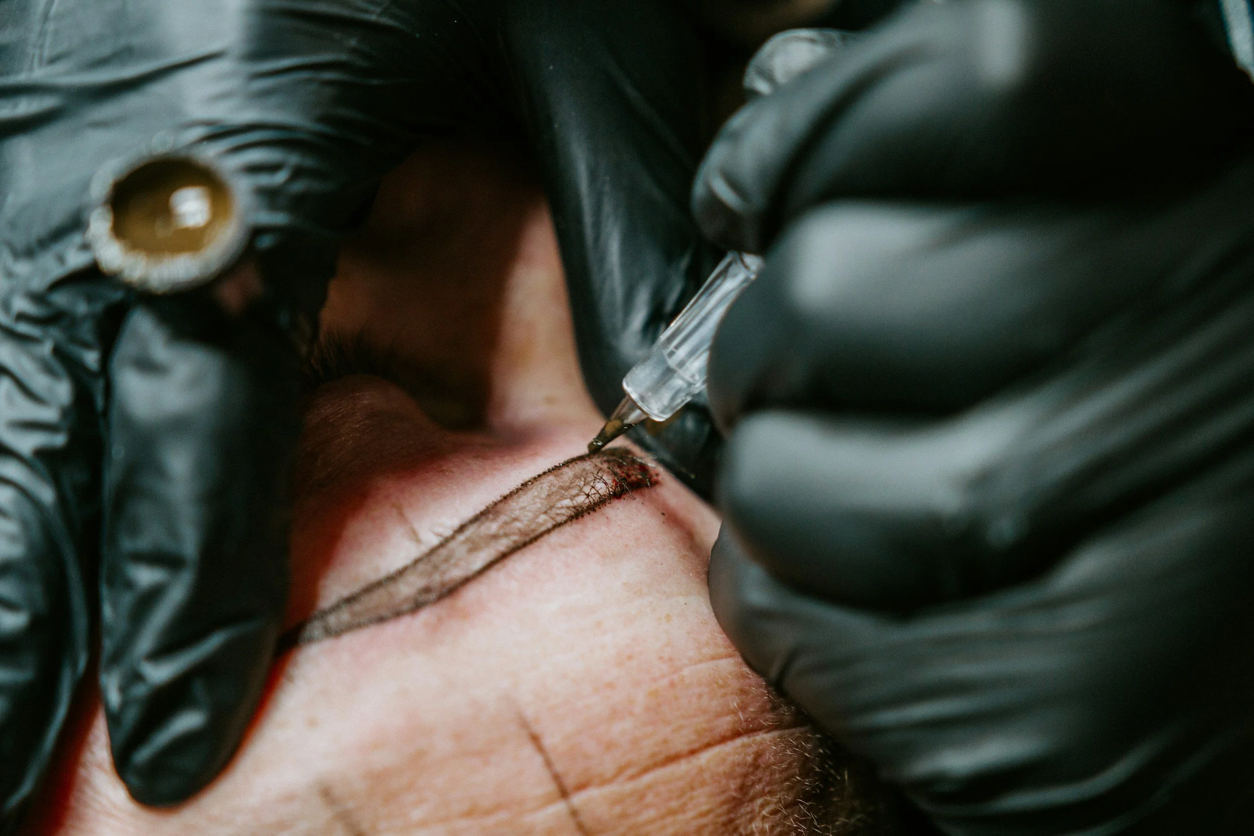 A tattoo artist is performing a tattoo on a person's skin. The artist is wearing black gloves and holding a tattoo needle. The person's skin appears red and irritated from the tattoo procedure.