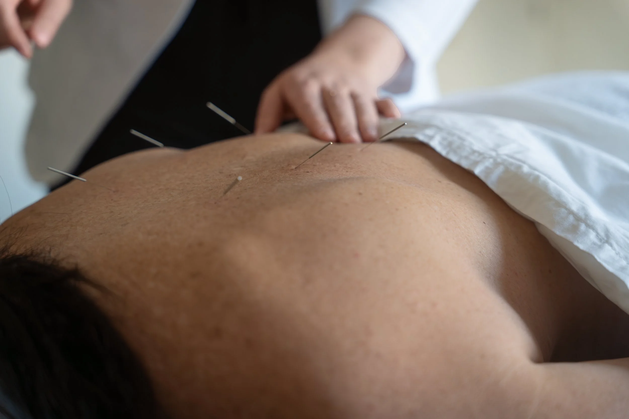 A person receiving acupuncture treatment with multiple thin needles inserted into their back at clinic in Lacombe Alberta
