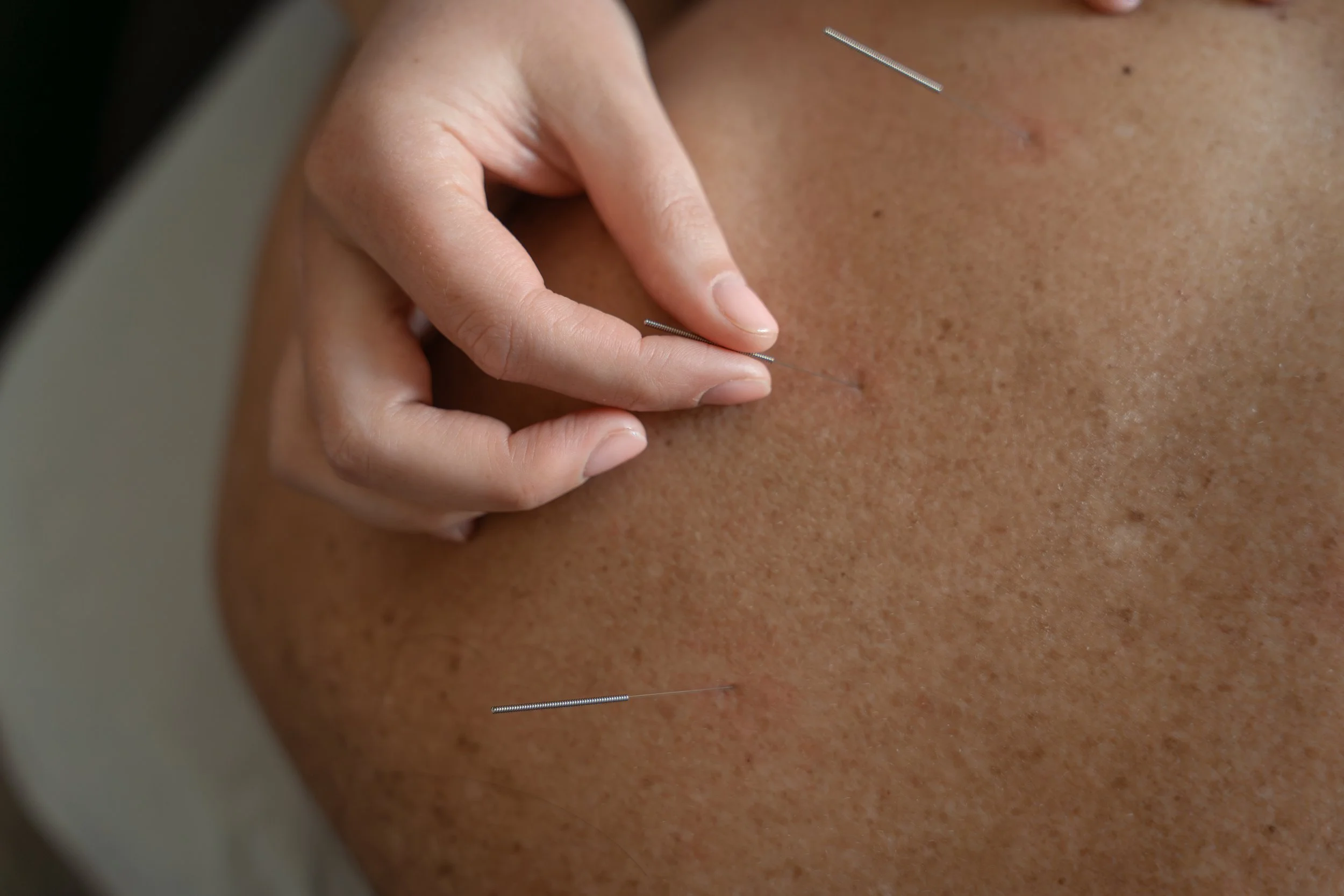 Close-up of acupuncture needles inserted into skin at traditional chinese medicine clinic in Lacombe Alberta.