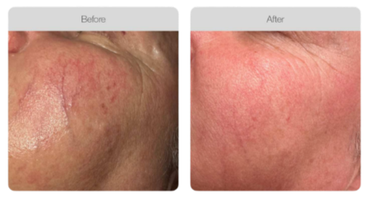 Close-up of a cheek showing improvement in skin redness and texture after treatment, with a before and after comparison.