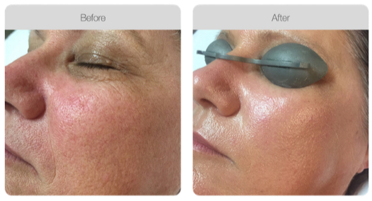 Side-by-side comparison of a person's face before and after a cosmetic procedure, showing smoother skin and reduced redness after treatment.