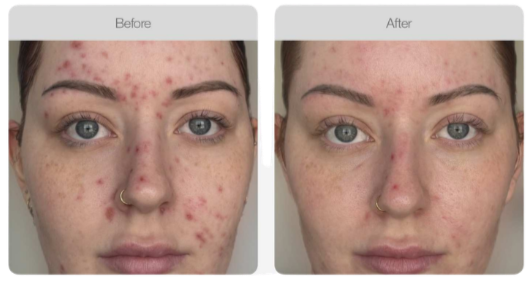 Comparison of a woman’s face showing acne before and after treatment, with clearer skin in the after photo.