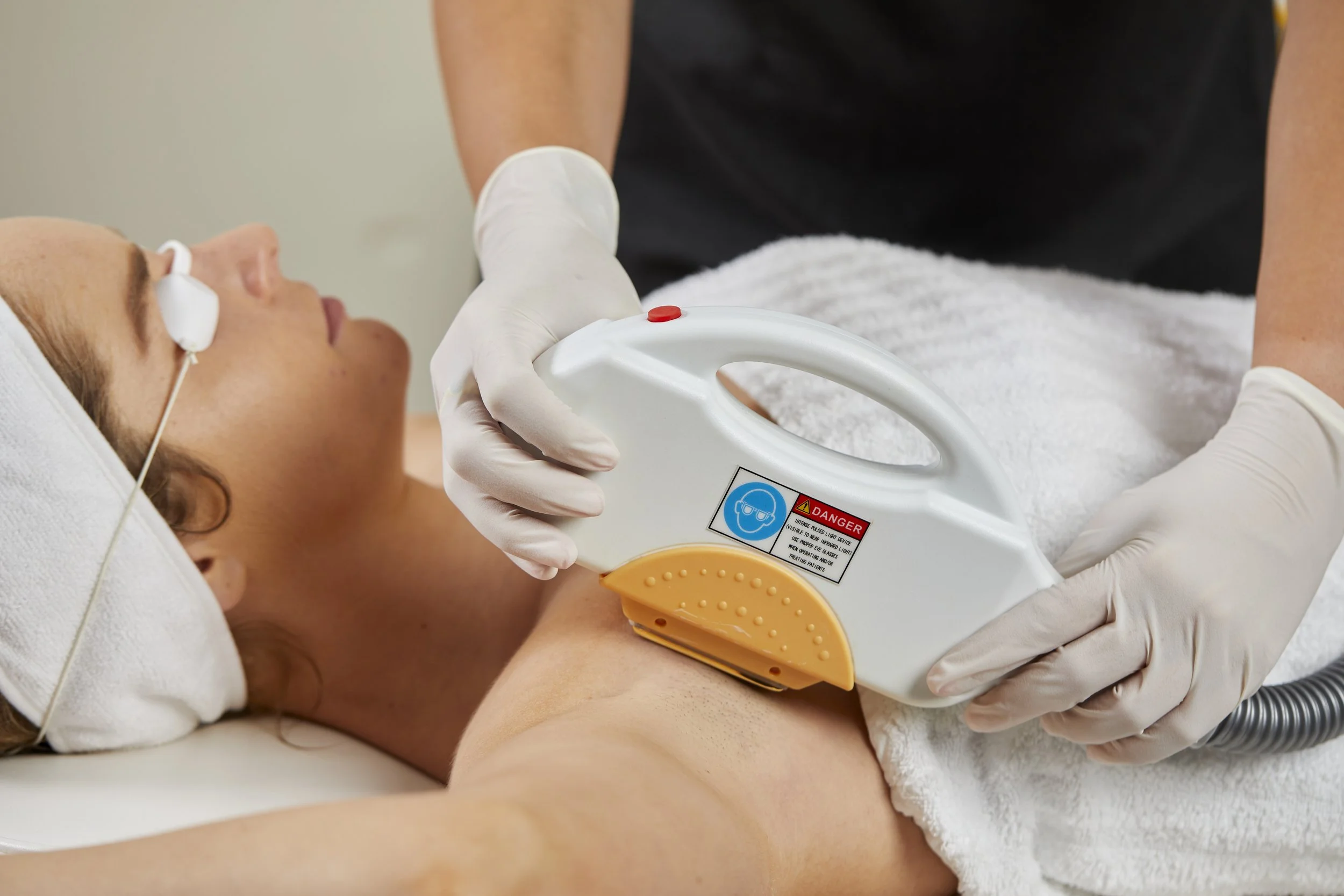 IPL hair removal treatment in Wickham