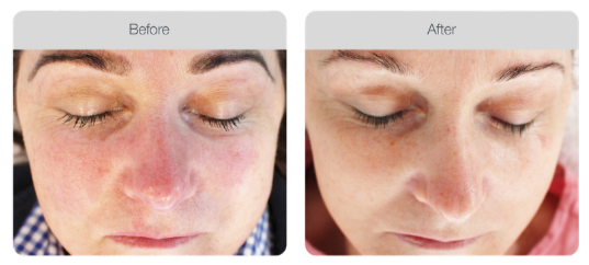 Comparison of a woman's face before and after skincare treatment, showing clearer skin in the after image.
