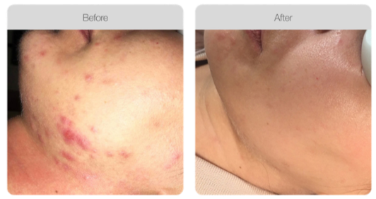 Comparison of skin on the chin area showing acne before and clear skin after treatment.