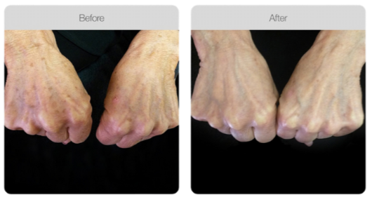 Comparison of hands before and after treatment showing reduced skin imperfections and improved appearance.