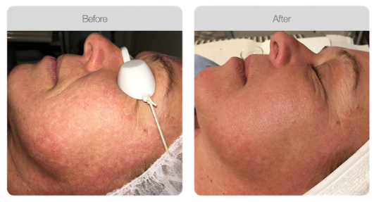 Side-by-side comparison of a woman's face before and after skincare treatment, showing clearer skin and reduced redness in the after image.