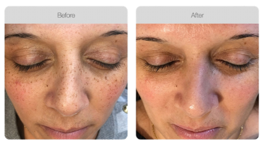 Comparison of a woman's face before and after skincare treatment, showing reduced freckles and improved skin clarity.