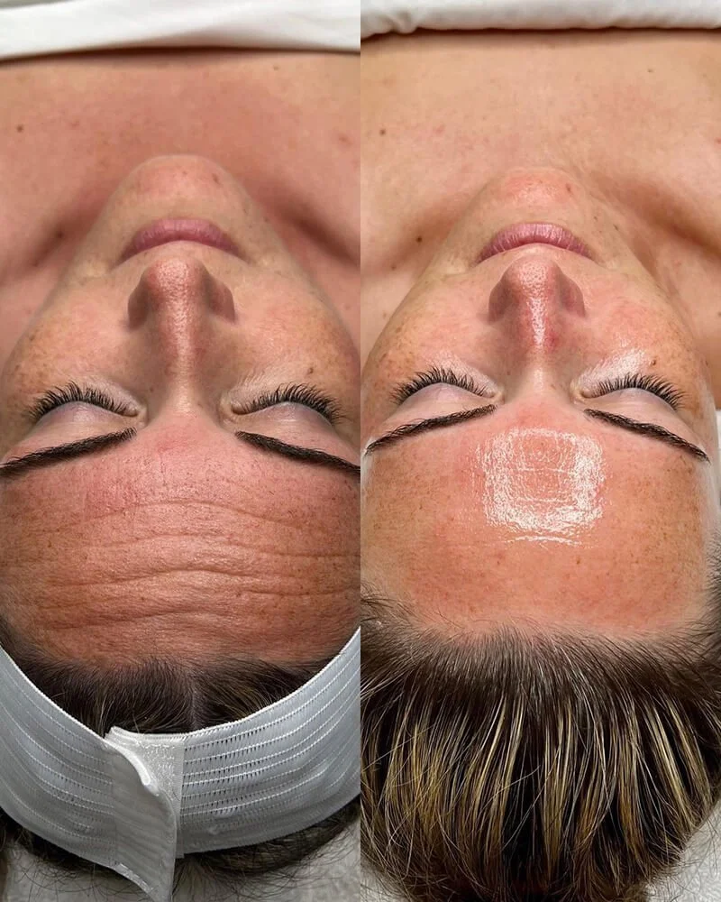 Side-by-side comparisons of a woman's forehead and face before and after a skincare treatment, showing reduced wrinkles and improved skin texture.
