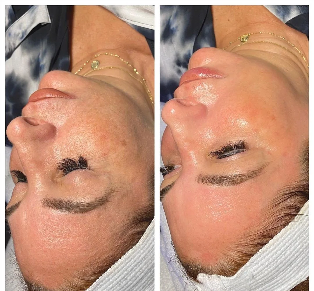 Side-by-side comparison of a woman's face before and after a skincare treatment, showing clearer, more radiant skin on the right.