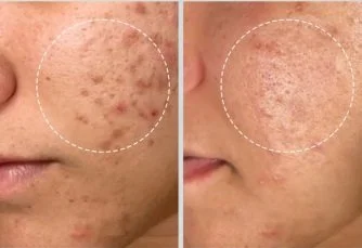 Close-up of a person's cheek showing acne scars and skin texture in before and after comparison.
