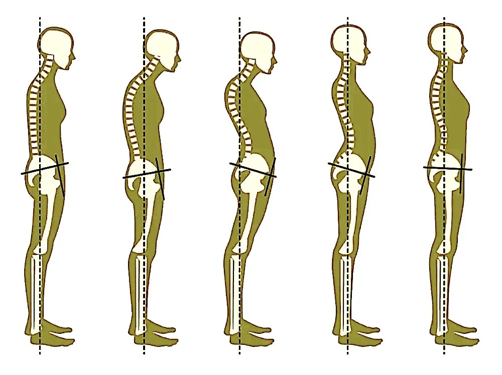 Illustration showing five side-view silhouettes of a woman standing with an exaggerated forward-tilted posture, depicting different stages of poor spinal alignment.