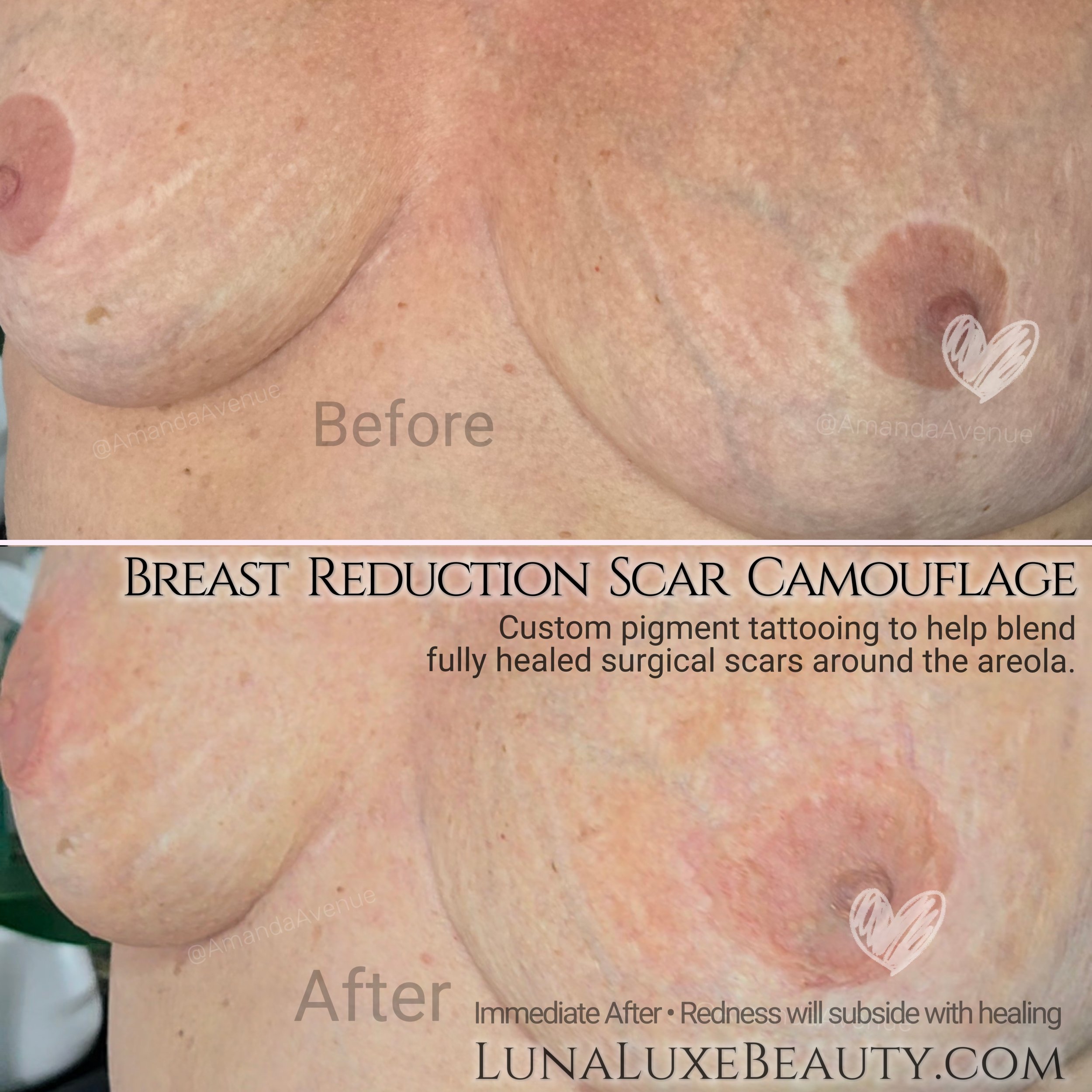 Tattoo ink around the areola from breast reduction making it look less visible with technique n tattoo ink