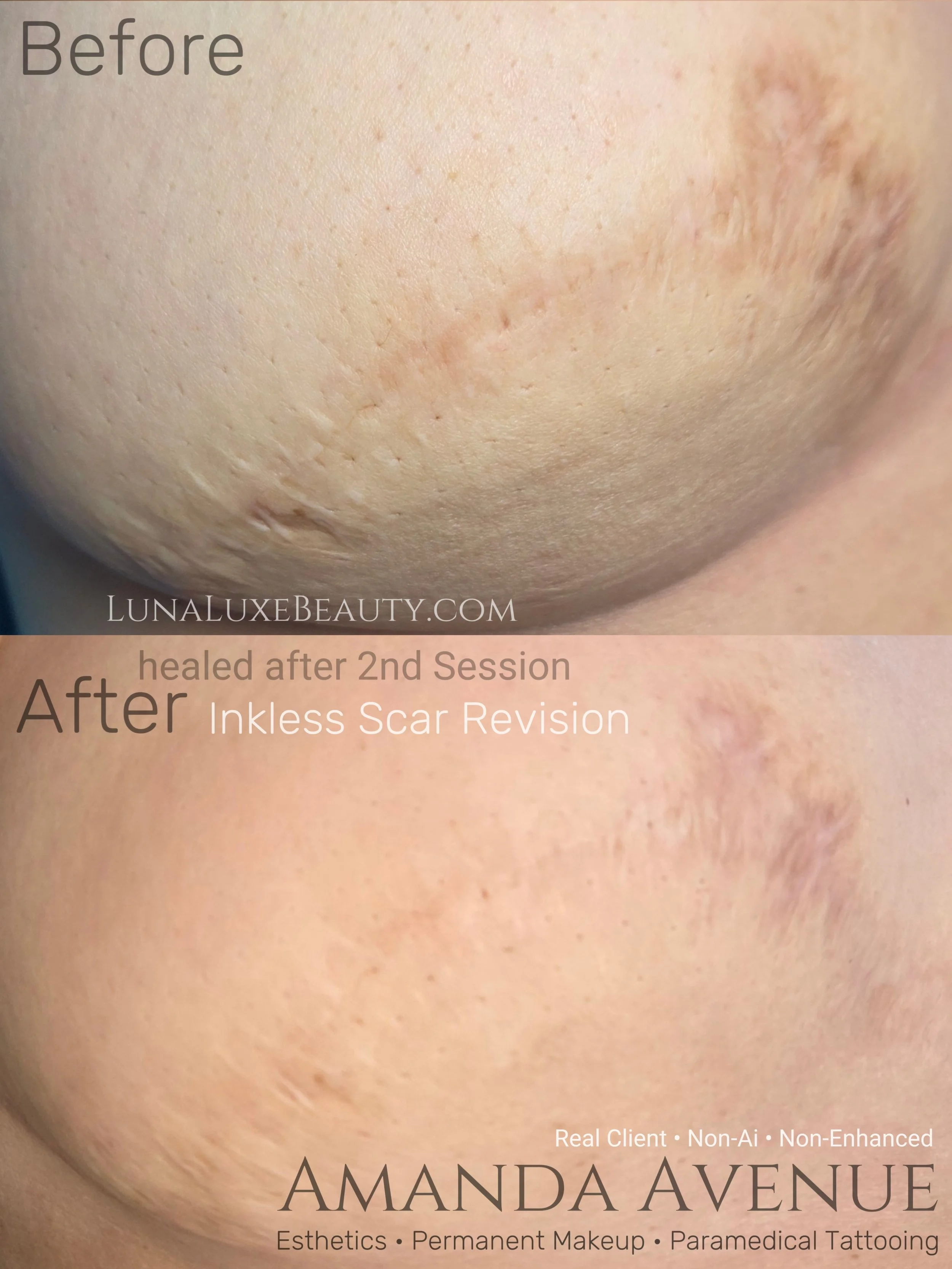 Before and after inkless scar revision showing improvement in the appearance and texture of a fully healed scar.