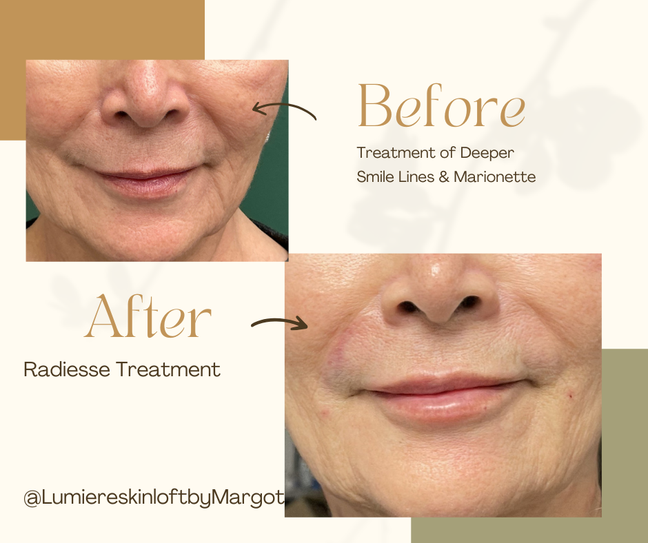 Radiesse Treatment