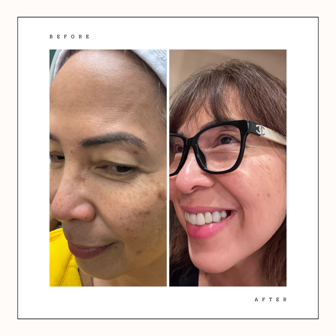 Hyperpigmentation