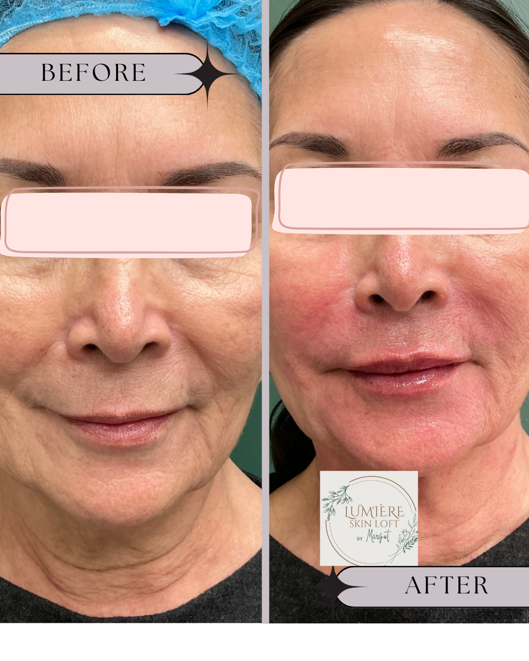 Lip Augmentation