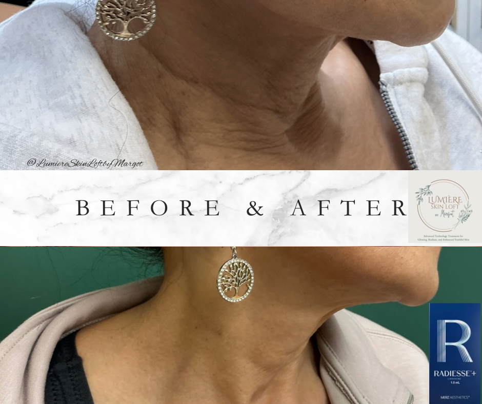 Neck Rejuvenation