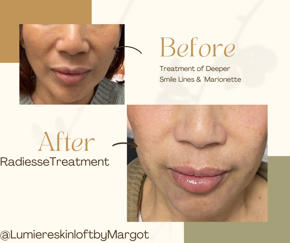 Radiesse Treatment