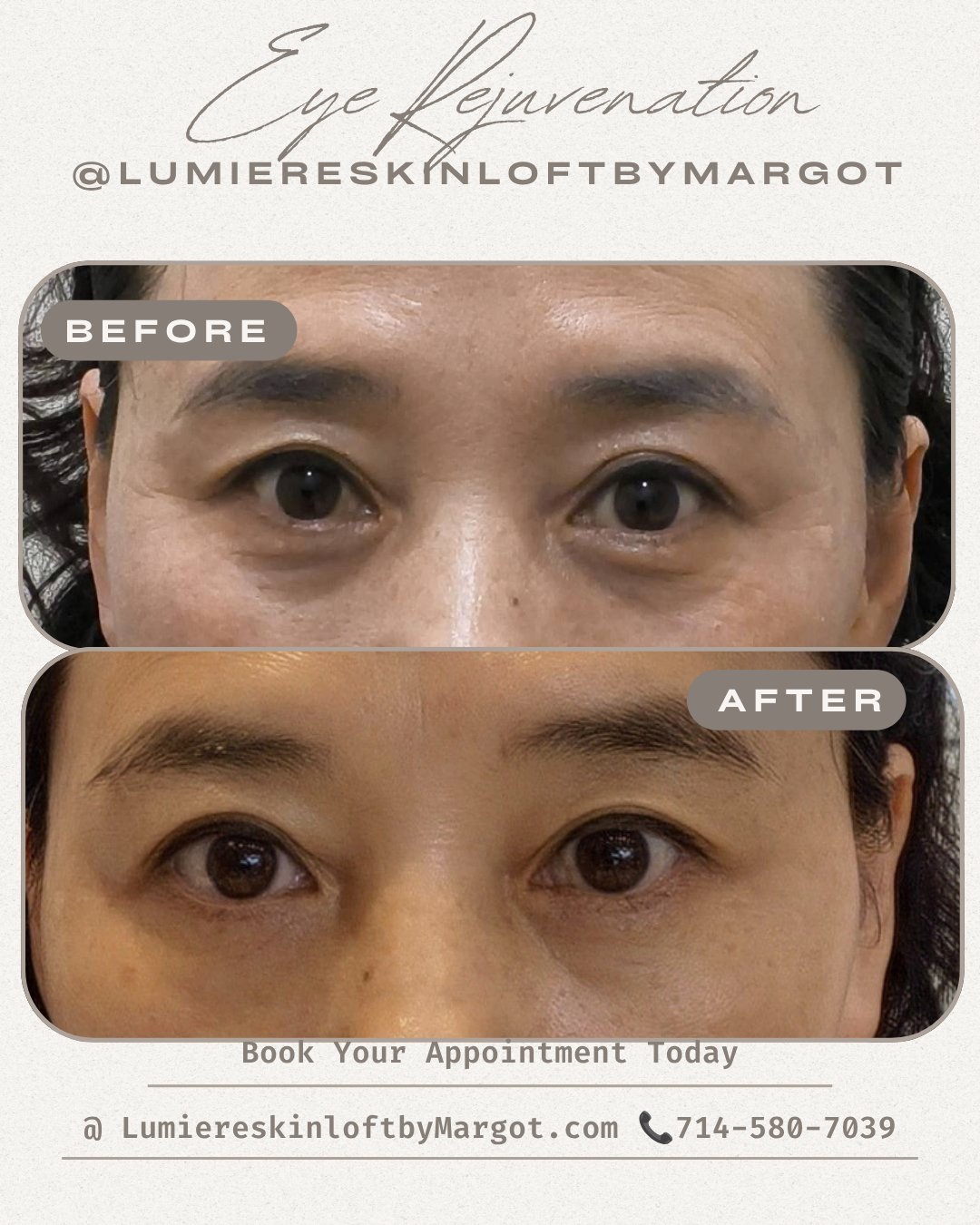 Eye Rejuvenation