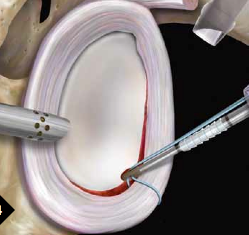 Labral Tear (Bankart lesion)