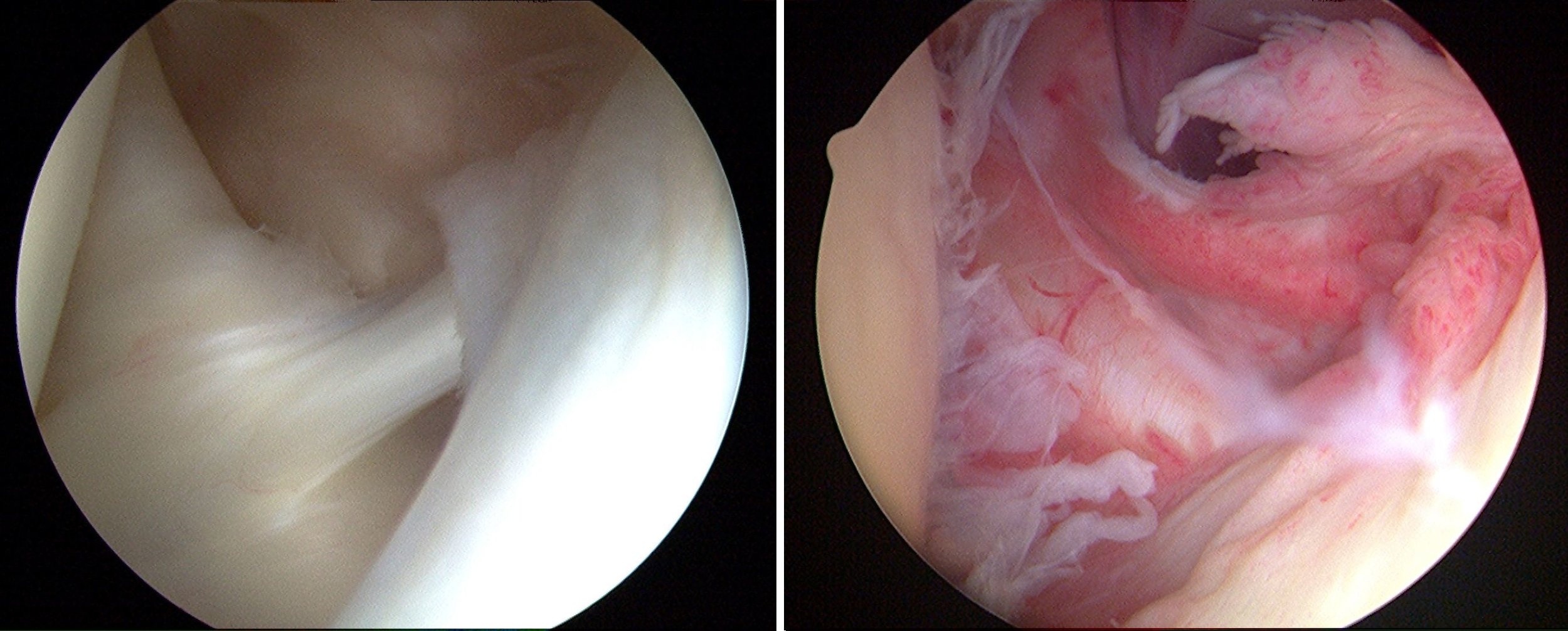 &nbsp; &nbsp; &nbsp; &nbsp; &nbsp; &nbsp; &nbsp; &nbsp; &nbsp; &nbsp; &nbsp; &nbsp; &nbsp;Normal shoulder &nbsp; &nbsp; &nbsp; &nbsp; &nbsp; &nbsp; &nbsp; &nbsp; &nbsp; &nbsp; &nbsp; &nbsp; &nbsp; &nbsp; &nbsp; &nbsp; &nbsp; &nbsp; &nbsp; &nbsp; &nb…