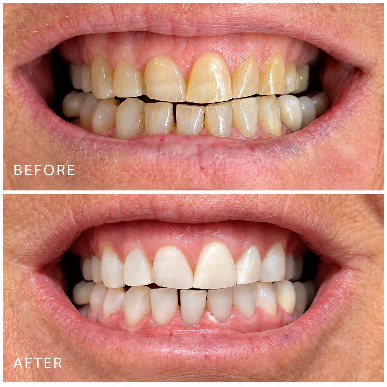 Comparison of teeth before and after dental cleaning or whitening; top image shows stained teeth, bottom image shows cleaner, whiter teeth.
