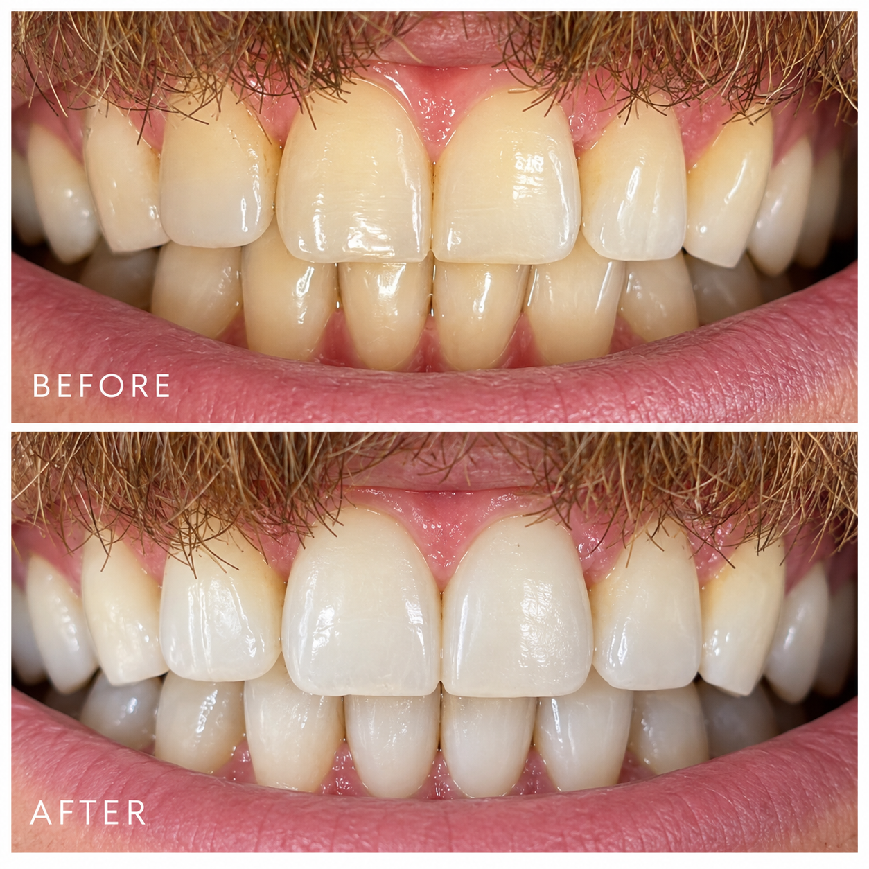 Close-up of a person's teeth before and after dental treatment. The 'before' image shows teeth with clear discoloration while the 'after' image shows teeth that are whiter and brighter.