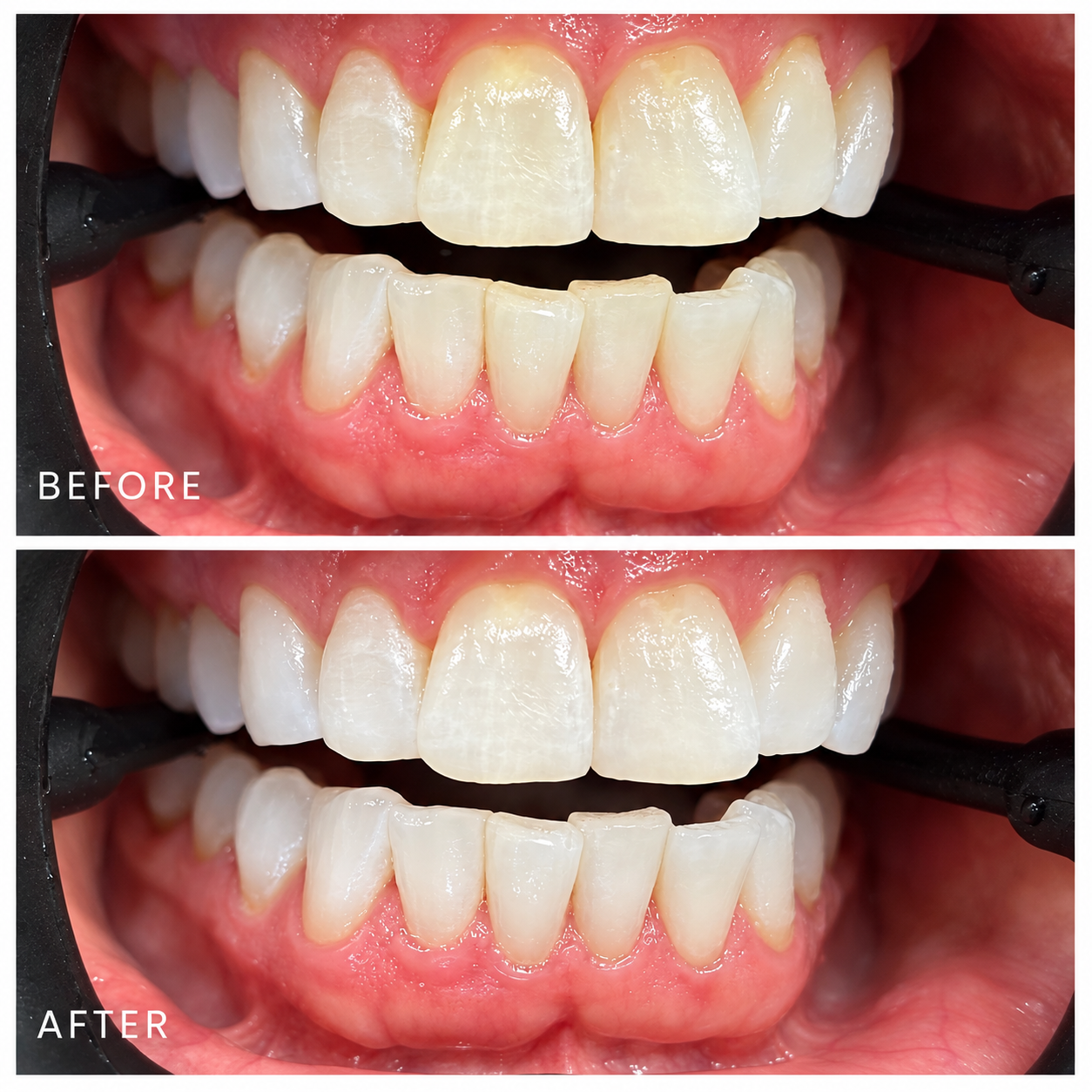 Close-up of person's teeth before and after dental treatment. Even as the patient already had relatively white teeth, the treatment is still showing improved whiteness and brighter teeth.