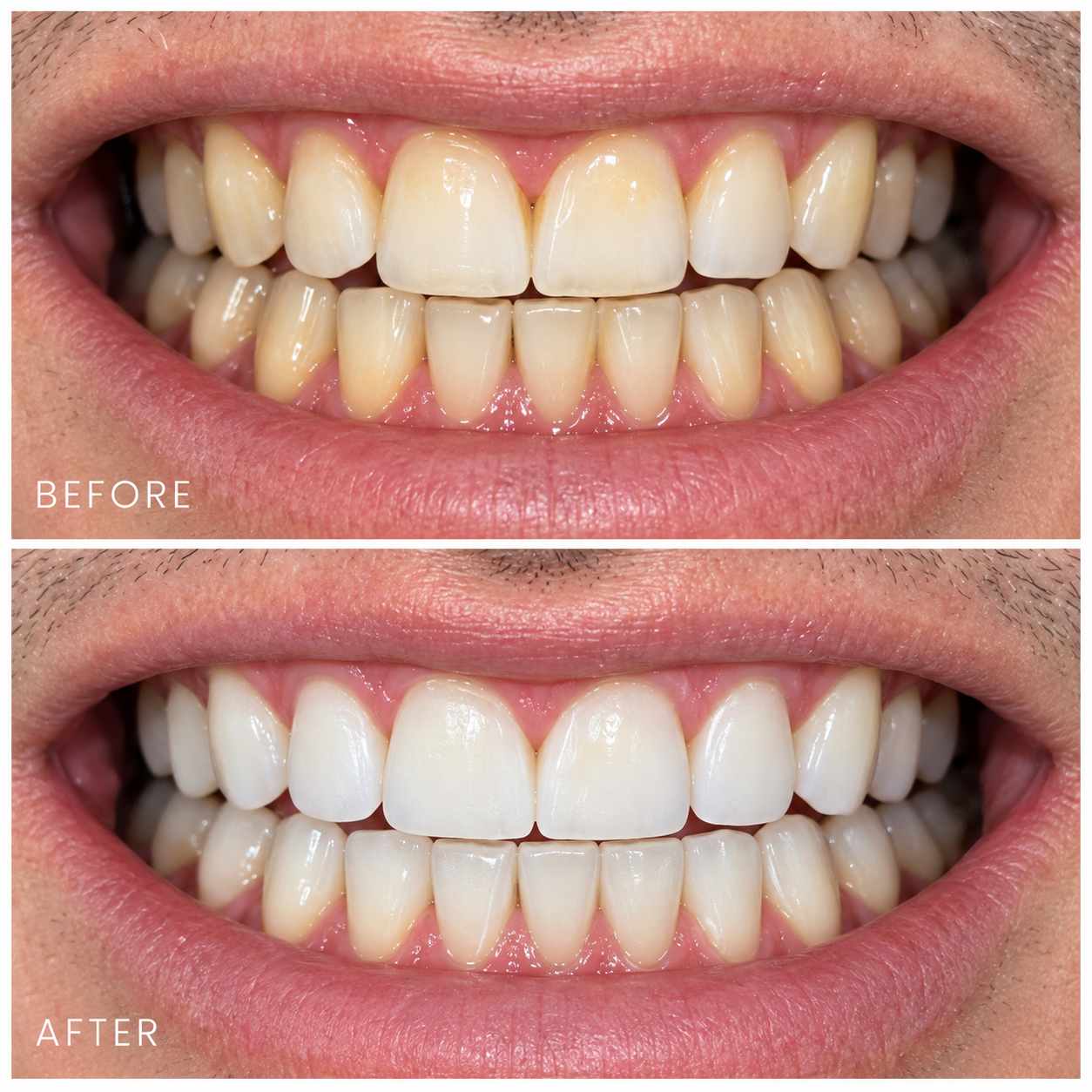 A close-up of a person's smiling mouth, showing before and after images of dental whitening. The "before" photo displays yellowed teeth, while the "after" photo shows visibly whiter teeth.