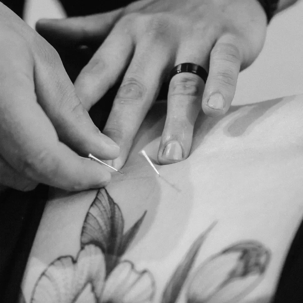 A person receiving acupuncture treatment on their back, with a practitioner inserting a thin needle.