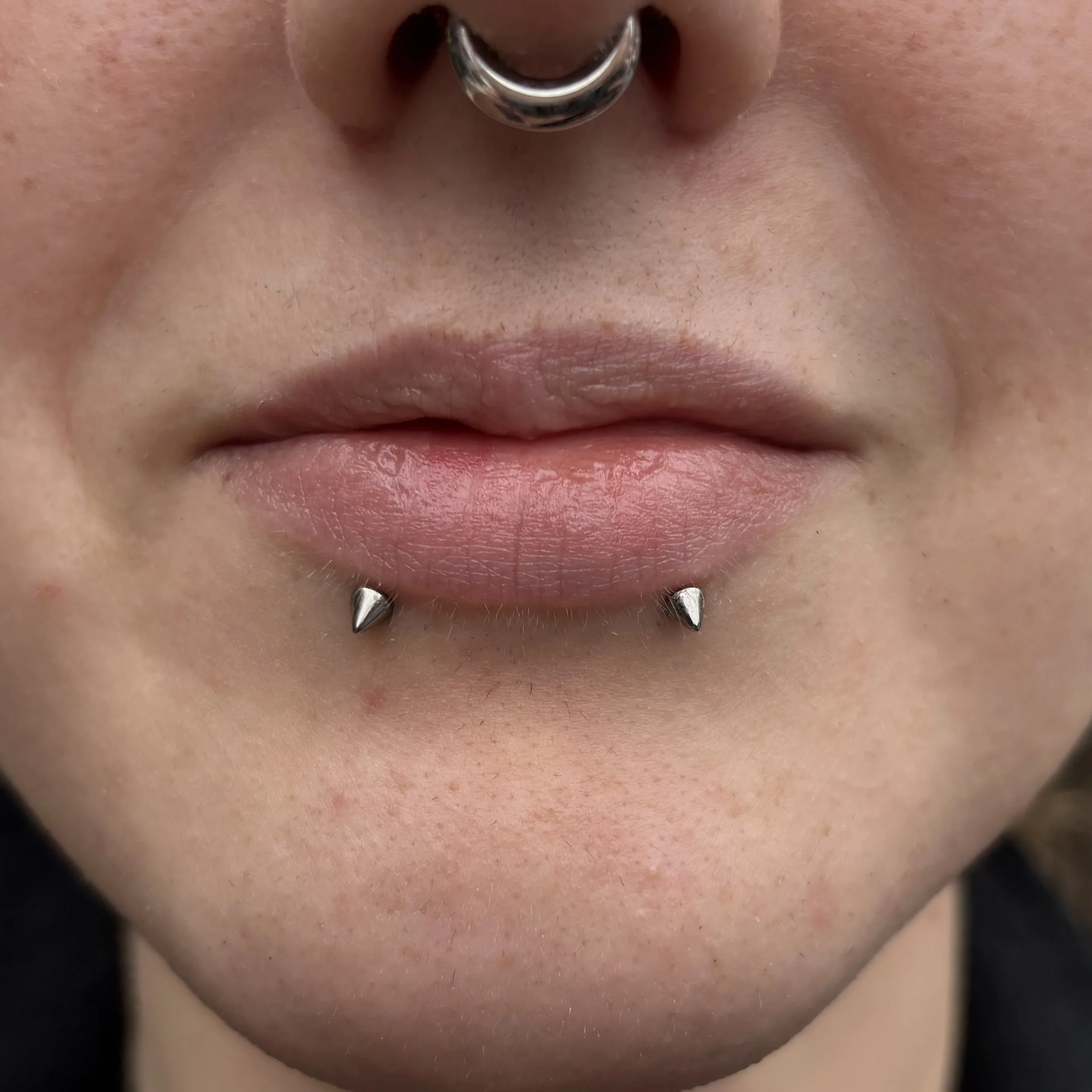 Healed Paired Lower Lips