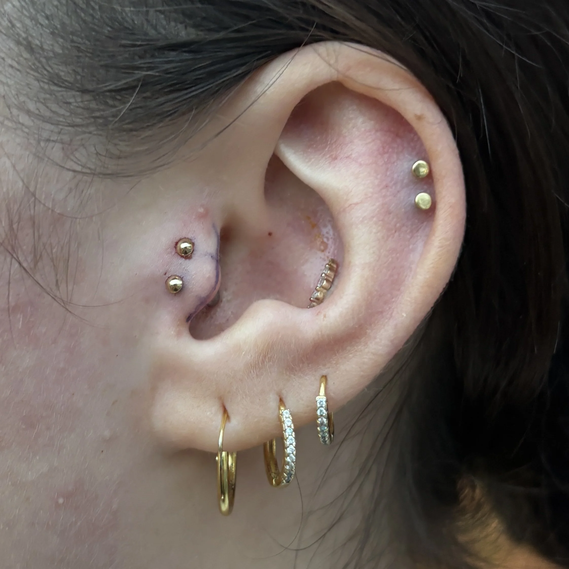 Double Tragus