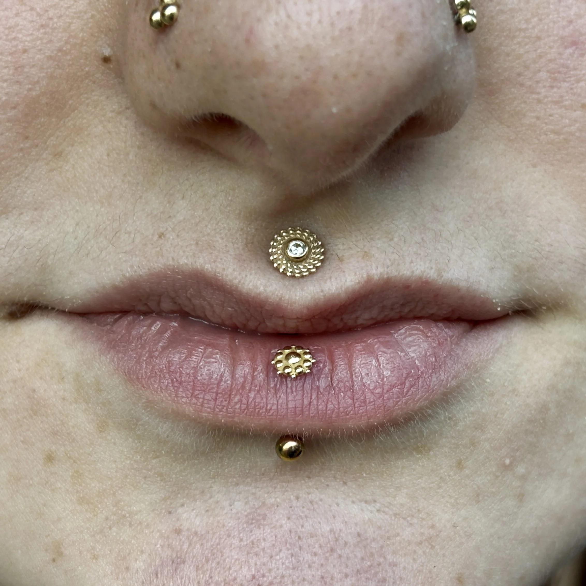Healed Philtrum & Vertical Labret