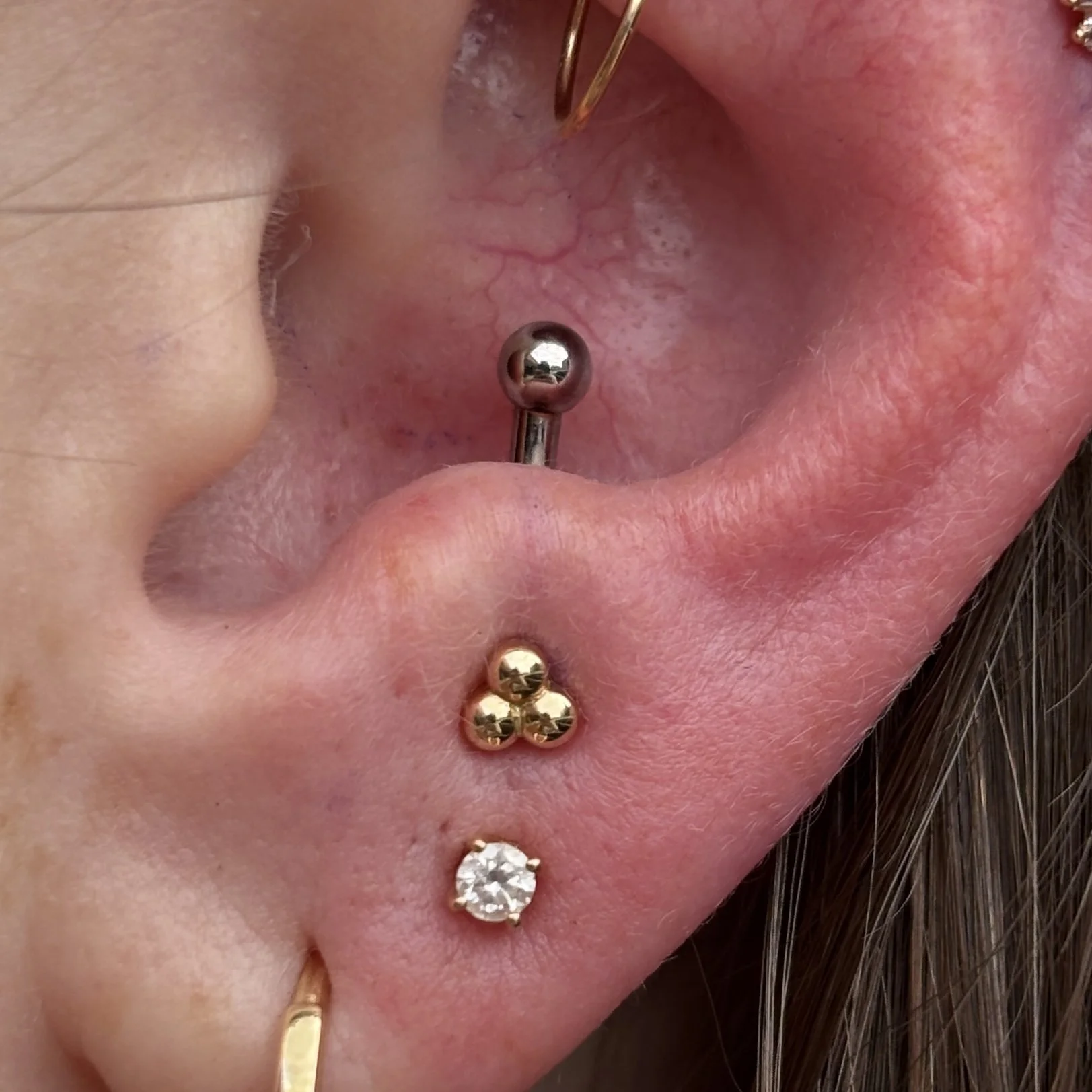 Anti-Tragus