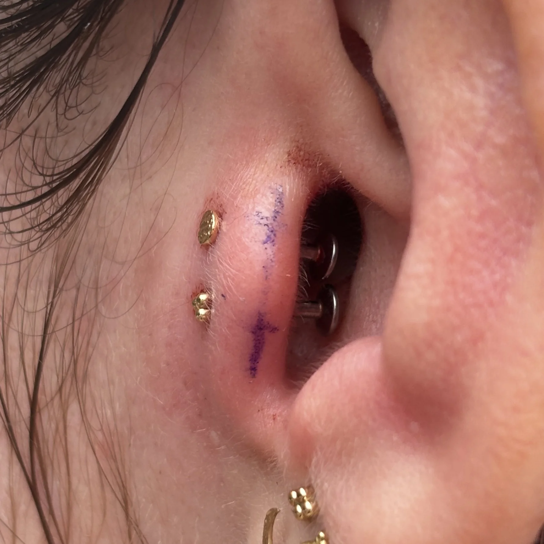 Double Tragus