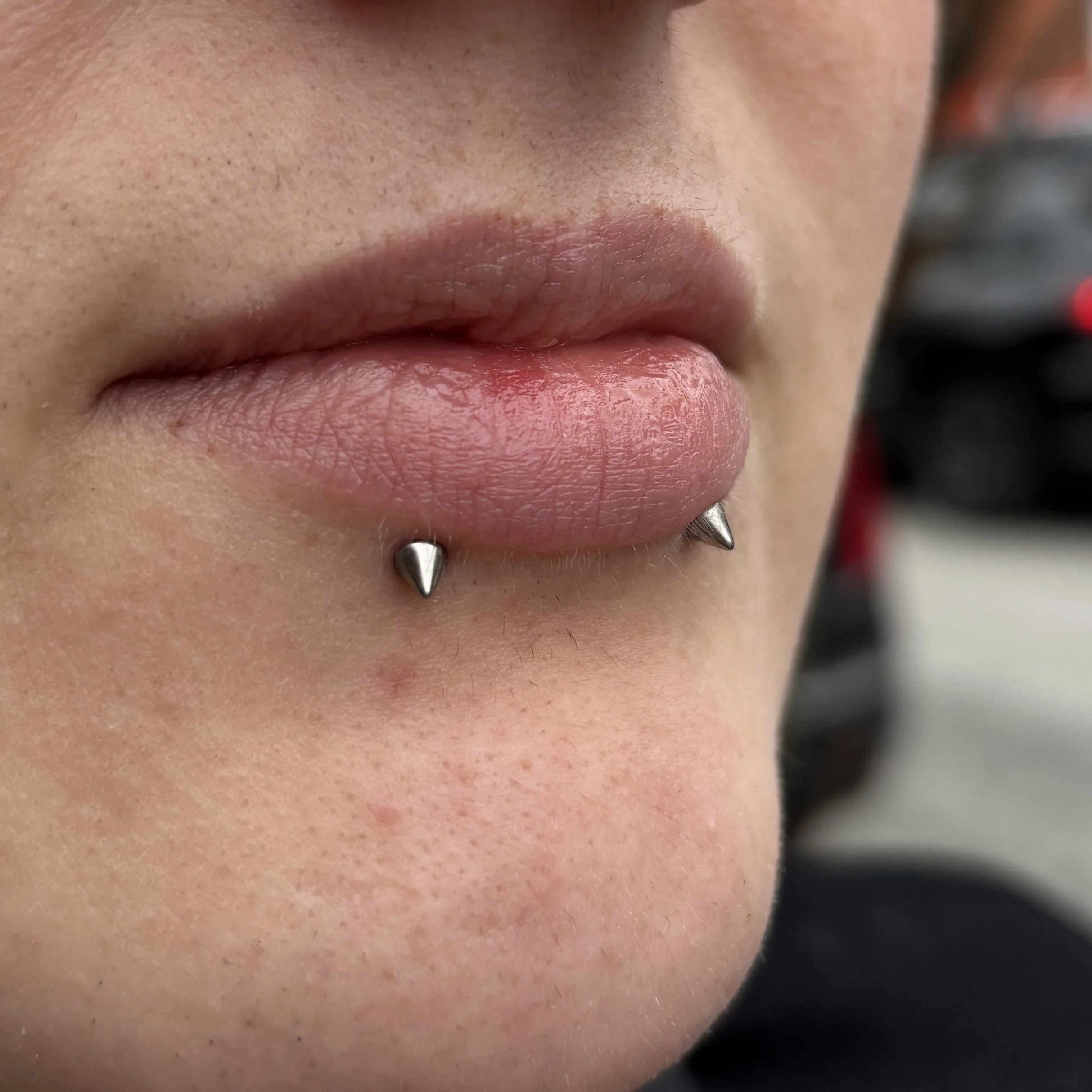Healed Paired Lower Lips