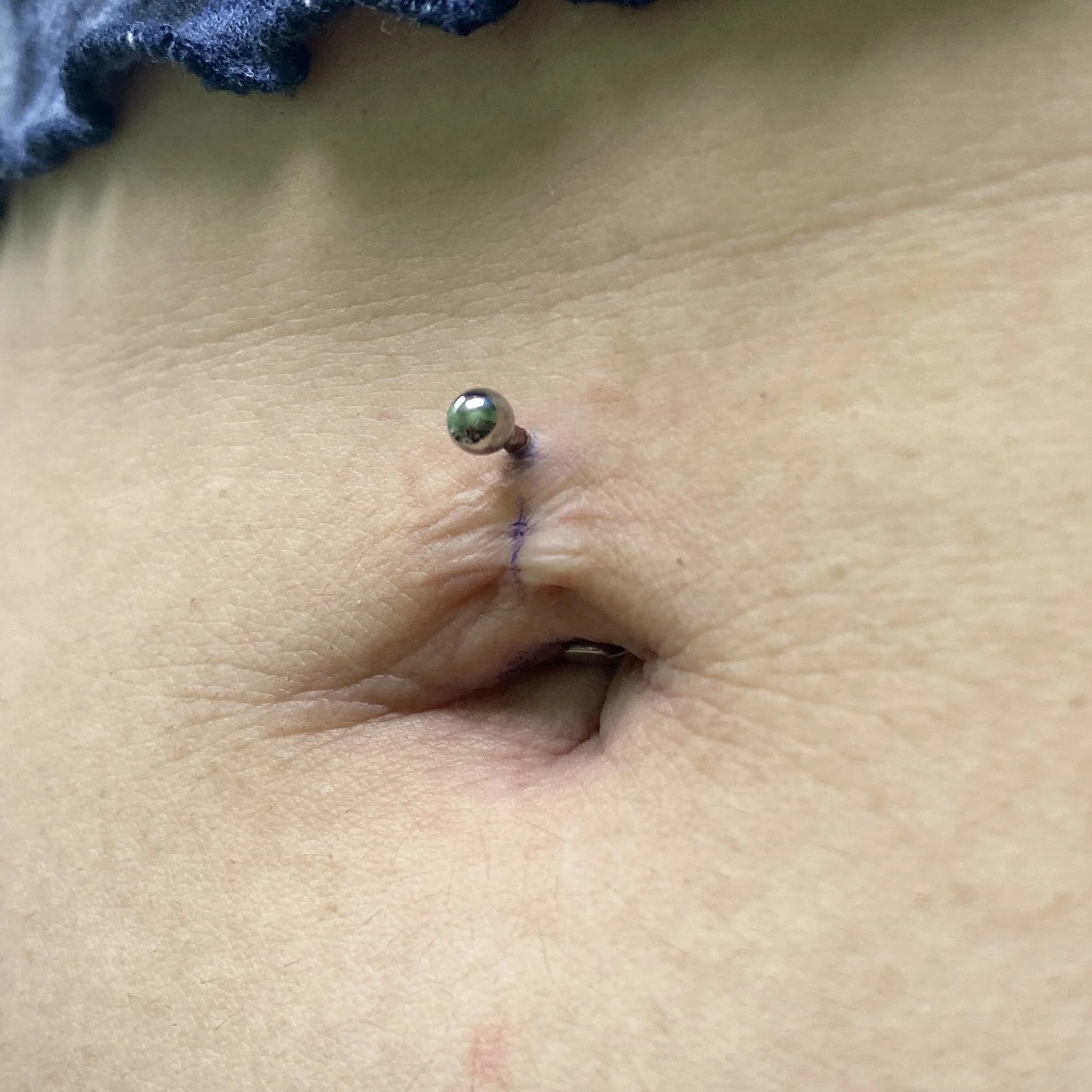 Floating Navel Behind Scar Tissue