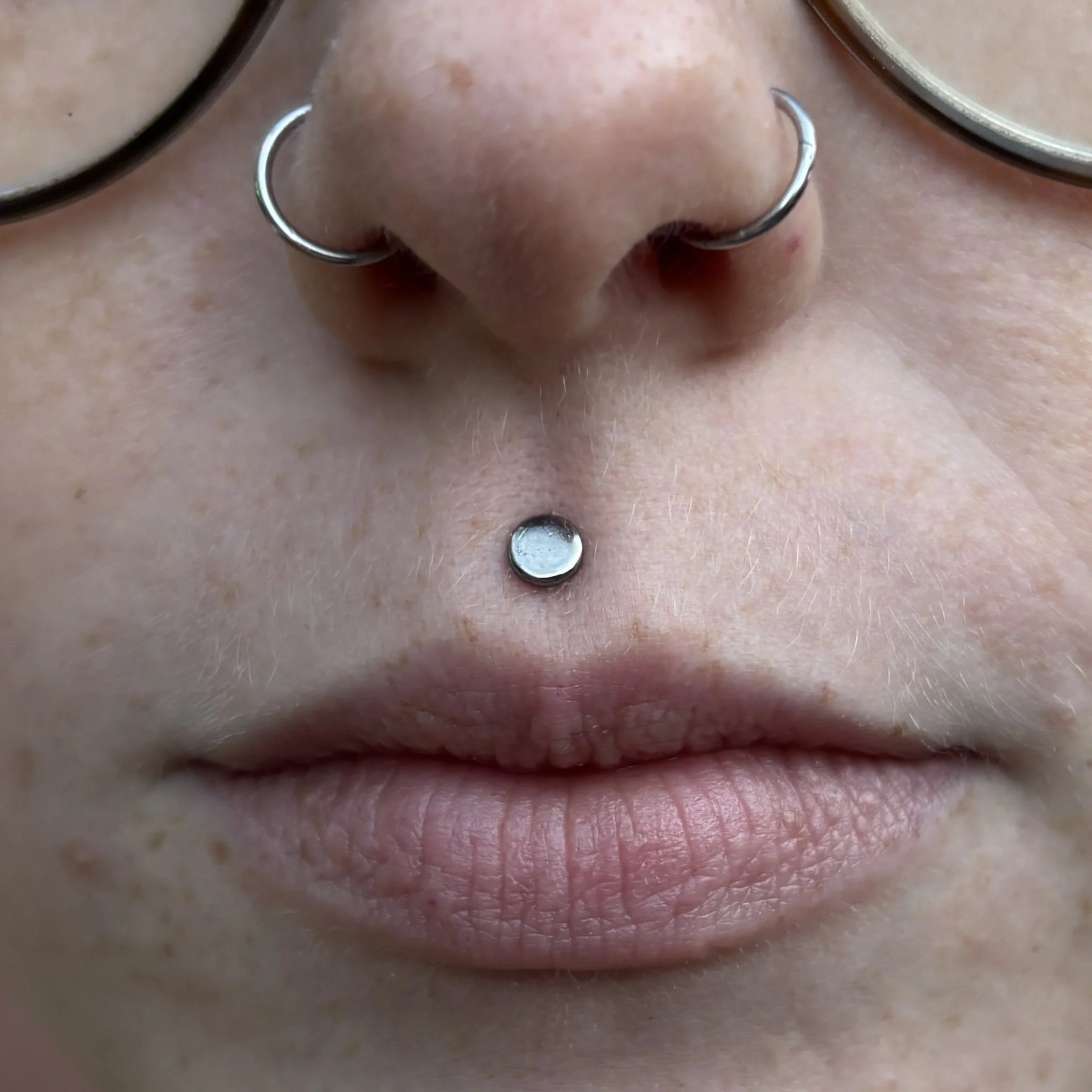Healed Philtrum