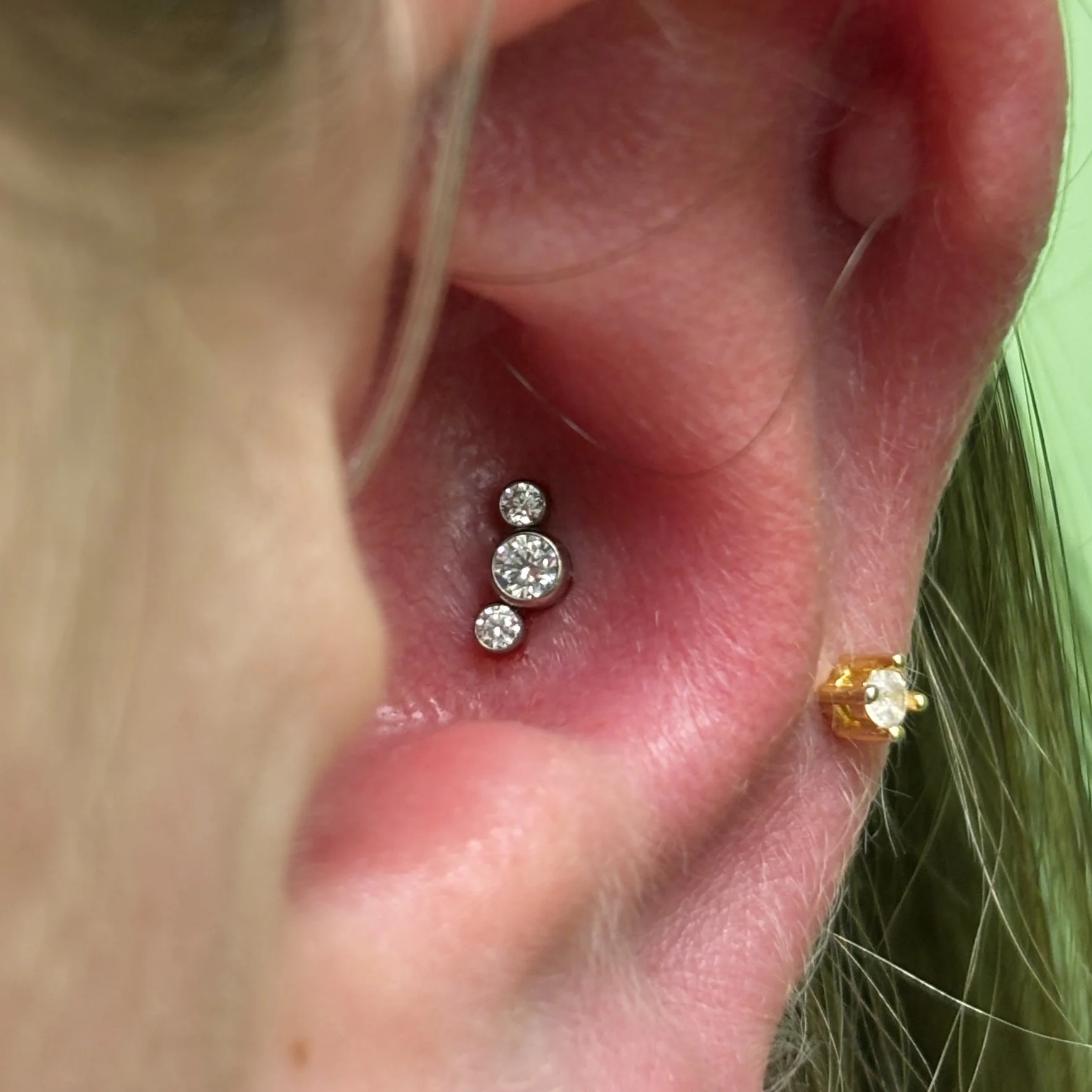 Conch (around hearing aid)