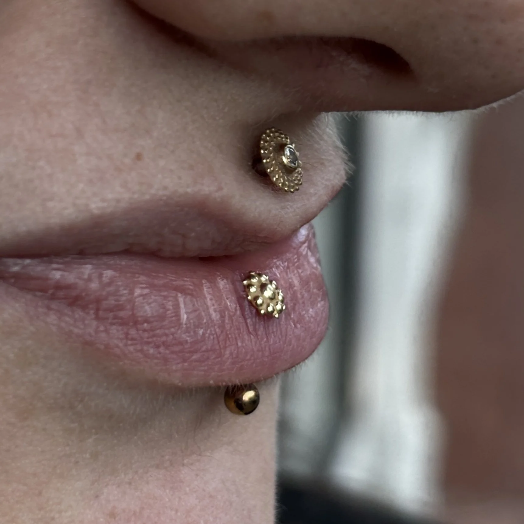Healed Philtrum & Vertical Labret