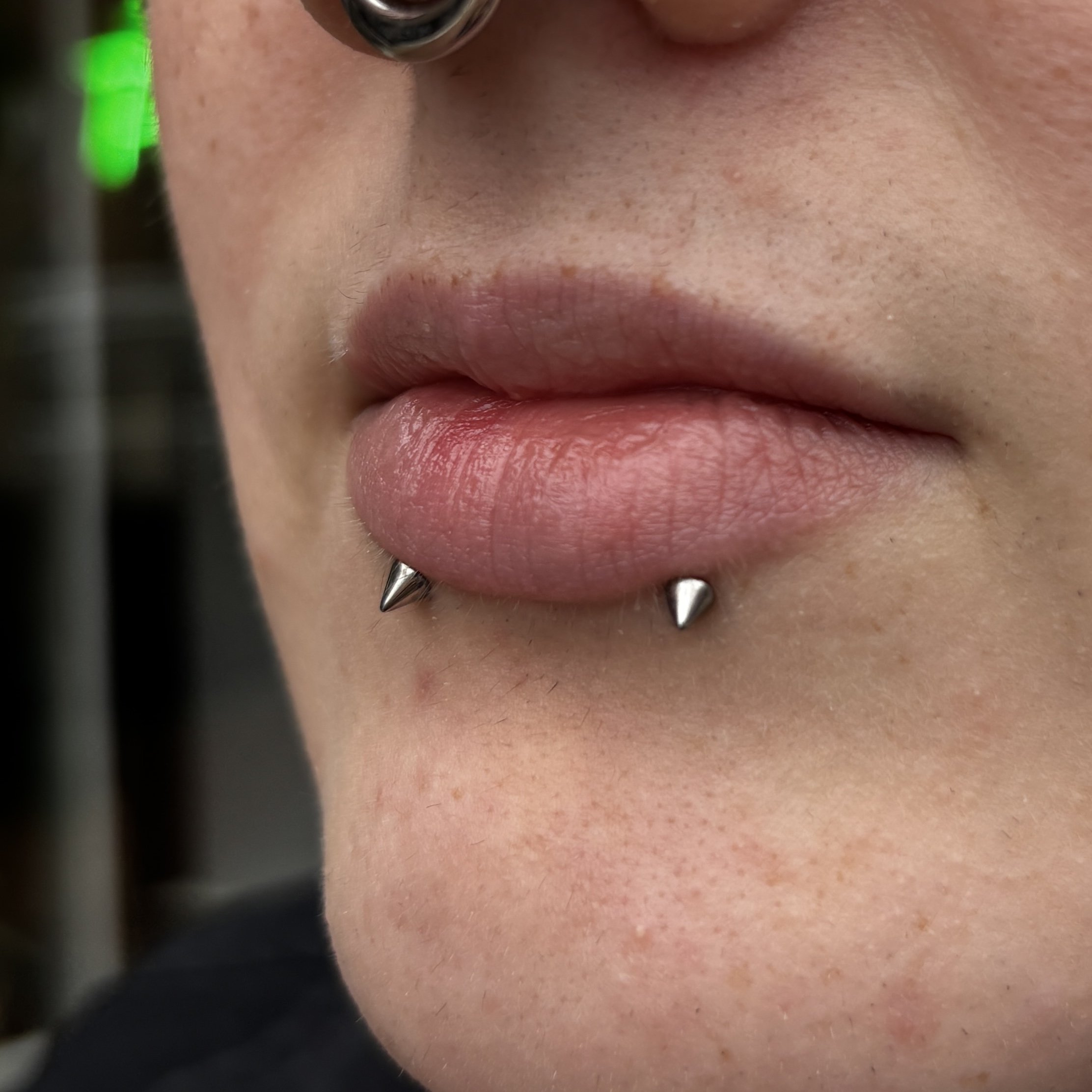 Healed Paired Lower Lips
