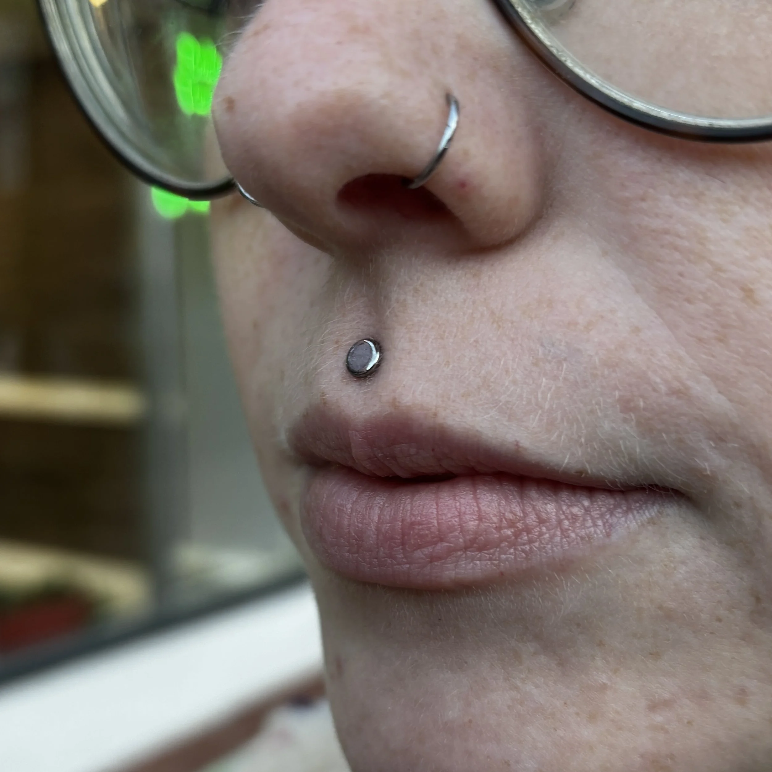 Healed Philtrum