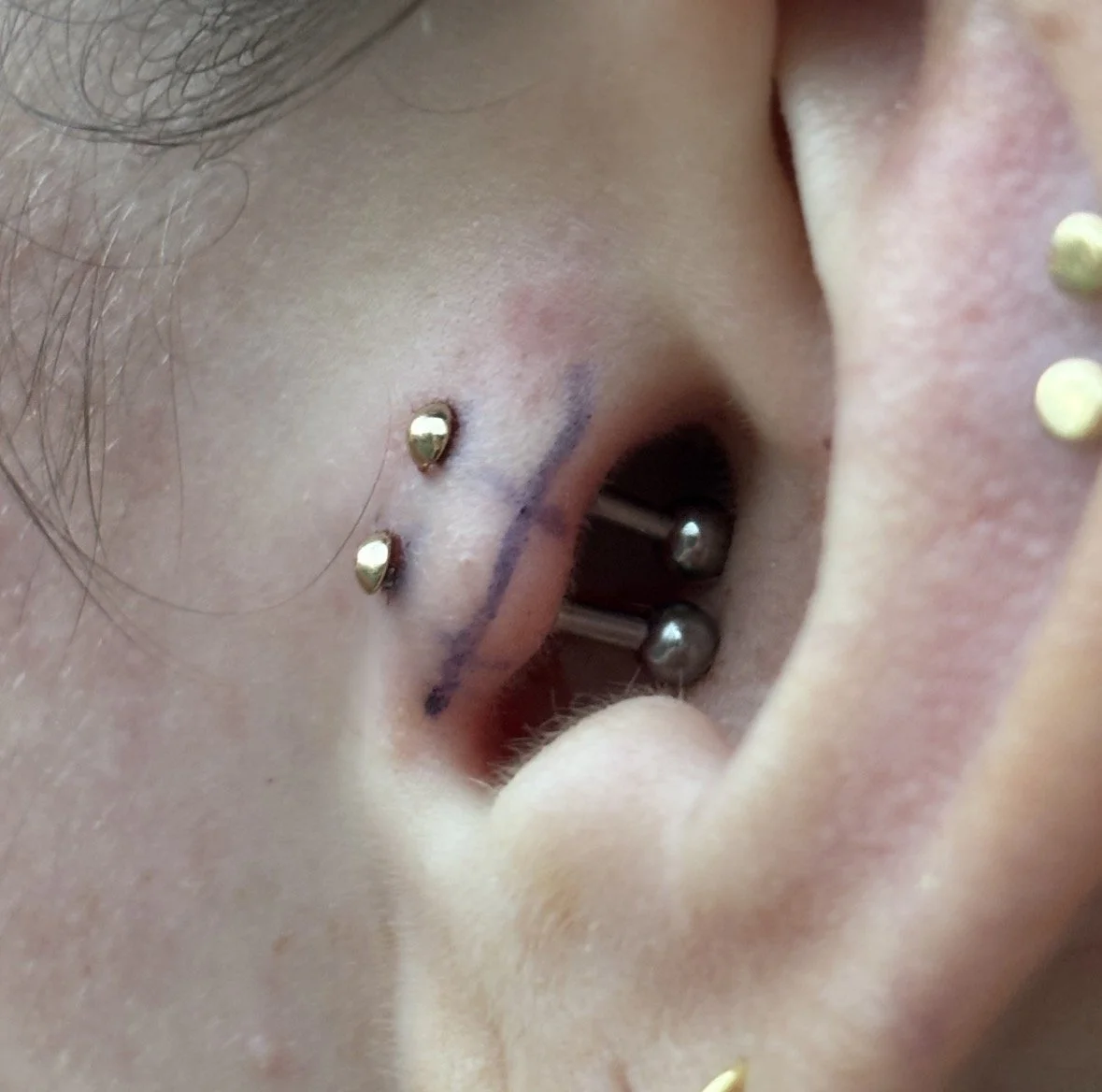 Double Tragus