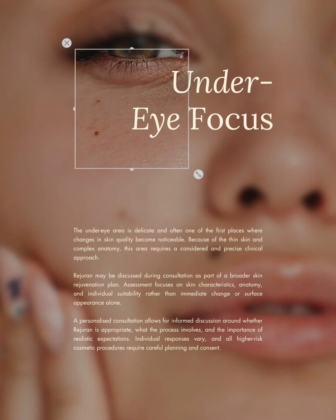 The under-eye is one of those areas where less really can be more. Delicate anatomy, subtle changes and very individual needs, which is why I&rsquo;ll always favour careful assessment over a one-size-fits-all approach. ☺️